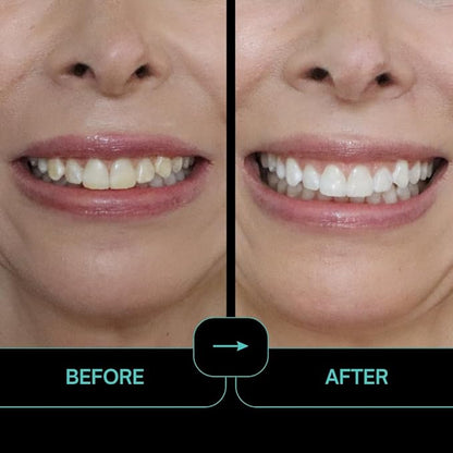 Prostrips - 12 Shades Whiter Teeth - 56 Enamel Safe REMINERALIZING Gentle Strips – 97% Had No Sensitivity - Bonus Size