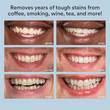 WHITE SMILE Teeth Whitening Kit, LED Light System, 35% Carbamide Peroxide 3 Gel Syringes, 10-Minute Treatment, Non-Sensitive Formula