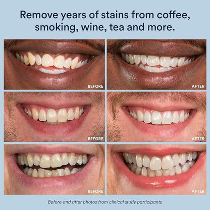 Auraglow Teeth Whitening Strips, Sensitive Whitening Strips, 14 Whitening Treatments, 8% Hydrogen Peroxide with Nano Hydroxyapatite (nHAp) to Reduce Sensitivity and Protect Enamel, 28 Strips, Mint
