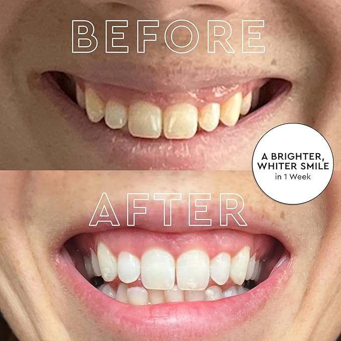 MOON LED Teeth Whitening Kit - Platinum Teeth Whitener Device + 28 Dissolving White Strips - Yellow, Blue, + Red Light Therapy Whitening Tray for Gum Health and Fresh Breath (4 Piece Kit)