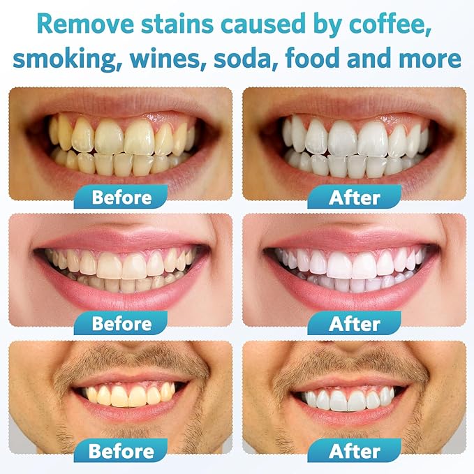 BESTEK Teeth Whitening Kit - 32X LED Teeth Whitening Light, 10 Min Fast Teeth Whitener with 4 Tubes of 35% Carbamide Peroxide Teeth Whitening Gel for Remove Coffee Wine Tobacco Teeth Stains - Blue