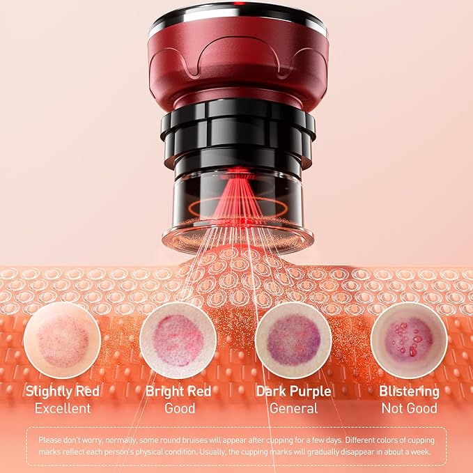 UBALANCE Smart Cupping Therapy Set - Cellulite Massager with 6 Massage Cups, Portable Electric Device for Enhanced Blood Circulation, Reduced Cellulite, and Muscle Soreness Relief（Red）