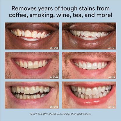 Auraglow Teeth Whitening Kit, LED Accelerator Light, 35% Carbamide Peroxide Teeth Whitening Gel, 20+ Whitening Treatments, Whitens up to 10 Shades in 7 Days